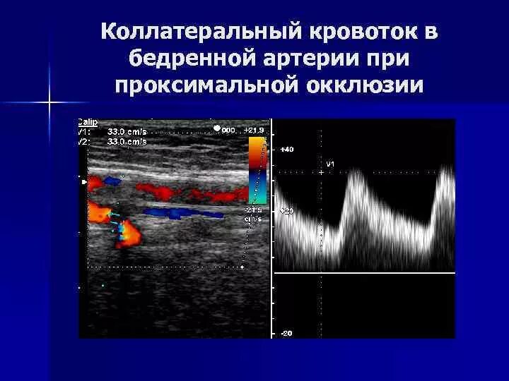 Пульсирующая гематома