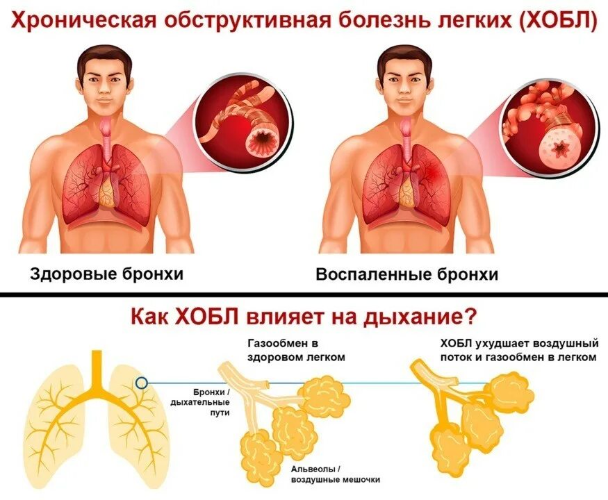 Опасное заболевание легких