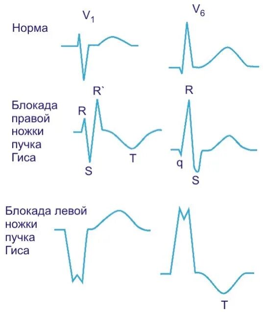 Что означает блокада правой ножки. Блокада левой нужки пуска оиса. Блокада левой ножки пучка Гиса. Блок левой ножки пучка Гиса на ЭКГ. Блокада левой ножки пучка Гиса (БЛНПГ.