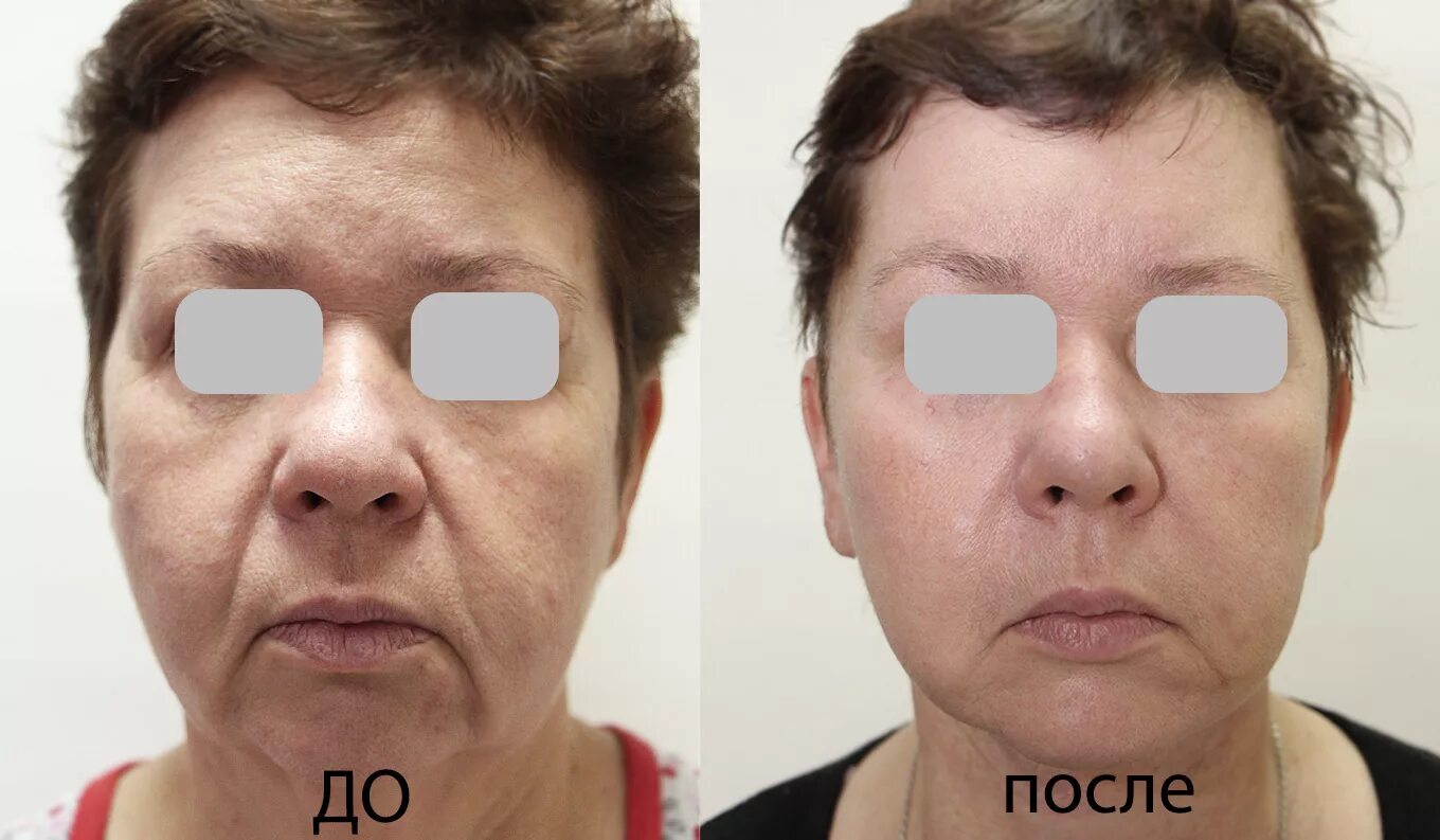 Седация при блефаропластике