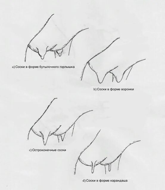 Формы сосков. Виды сосков. Неправильная форма сосков. Нормальная форма сосков.