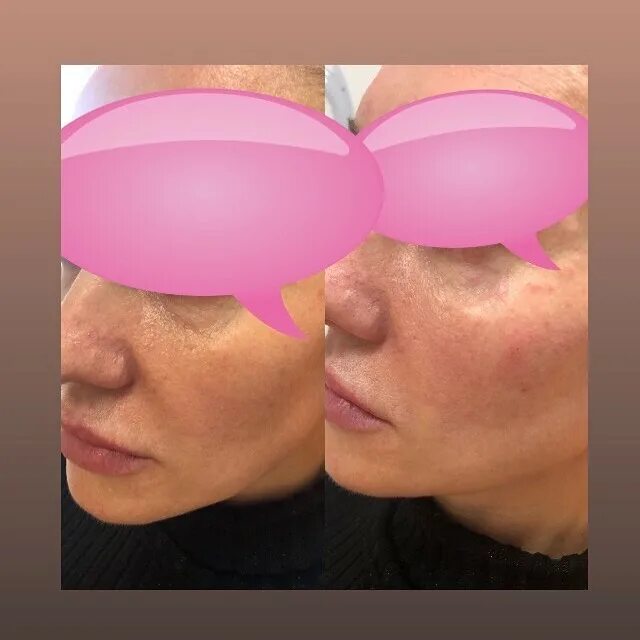 Ренессанс филлер. Препарат спектр для контурной пластики. Филлеры самара. Корейский препарат для губ хиалдьюти. Филлеры самара.