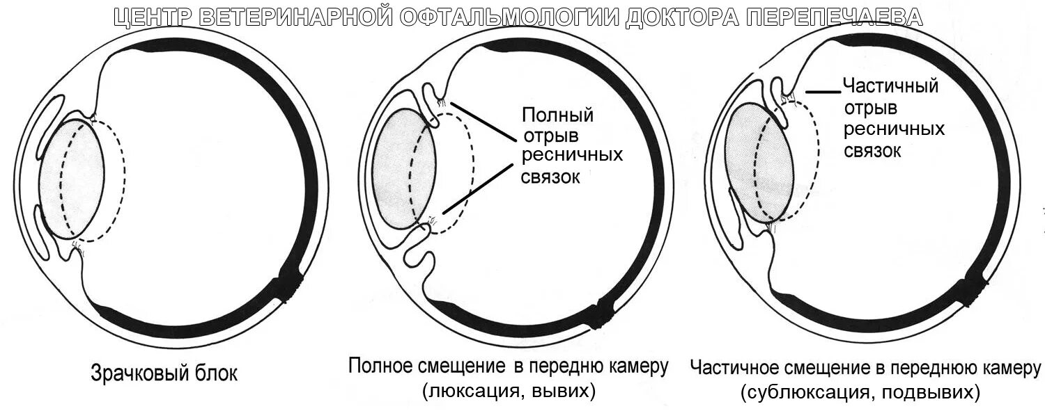 подвывих хрусталика в стекловидное тело. мидриаз медикаментозный. онхоцеркозный кератит. люксация хрусталика схема. кератит офтальмология.