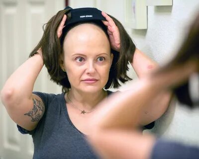 Выпали волосы после химиотерапии форум