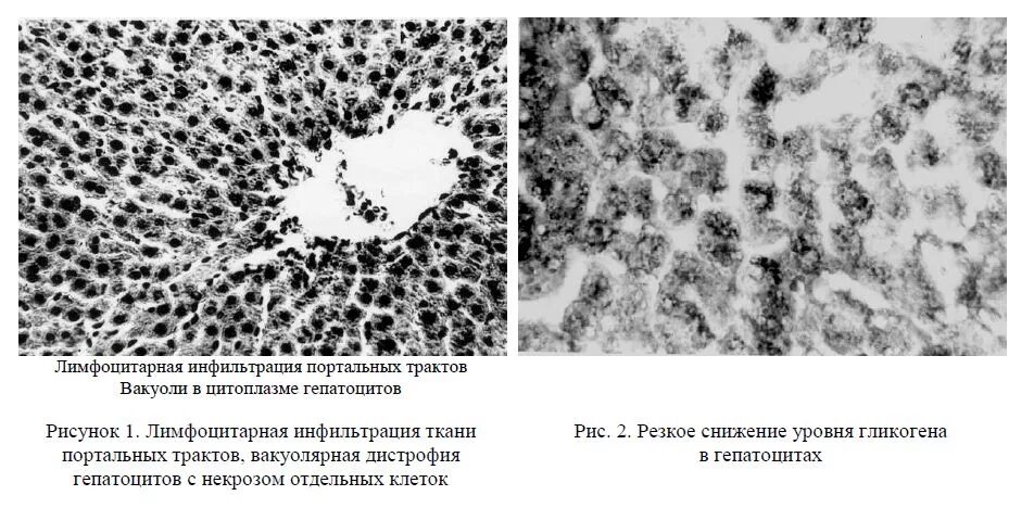 Лимфоидная инфильтрация что это. Лимфогистиоцитарная инфильтрация печени. Очаговая лимфогистиоцитарная инфильтрация. Лимфогистиоцитарная инфильтрация гистология. Очаговая лимфоцитарная инфильтрация стромы что это.