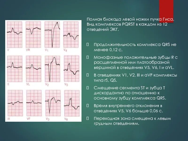 Полная блокада пучка ножки гиса лечение. Блокада левой ножки пучка Гиса на ЭКГ. Полная блокада пучка Гиса на ЭКГ. Блокада ножки пучка Гиса на ЭКГ. Полная блокада ЛНПГ на ЭКГ.