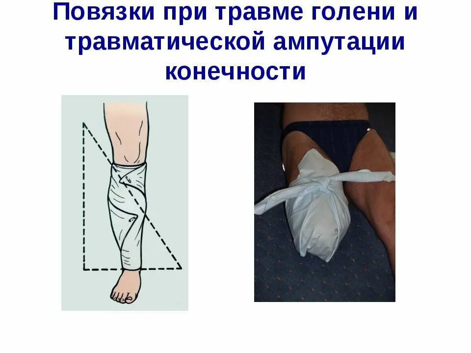 Помощь при травматической ампутации конечности