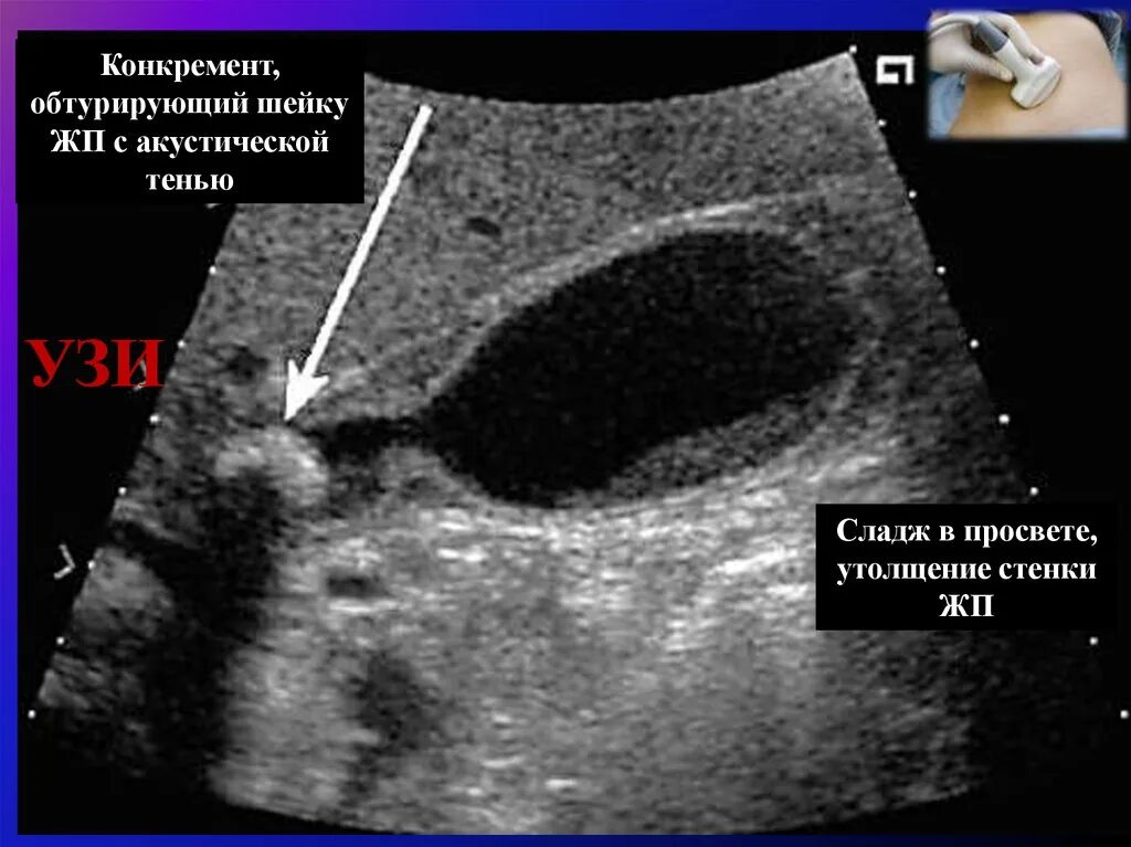 Узи жкб. Желчекаменная болезнь УЗИ. ЖКБ УЗИ акустическая тень. Желчнокаменная болезнь УЗИ.