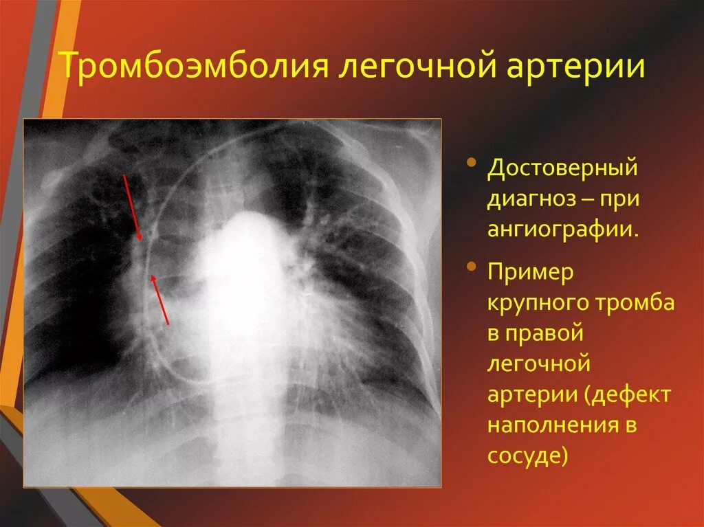 Острой тромбоэмболии легочной артерии. Тромбоэмболия легочной артерии. Закупорка тромбом легочной артерии. Тромболегочная эмболия. Тромбоэмболия легочной артерии симптомы.