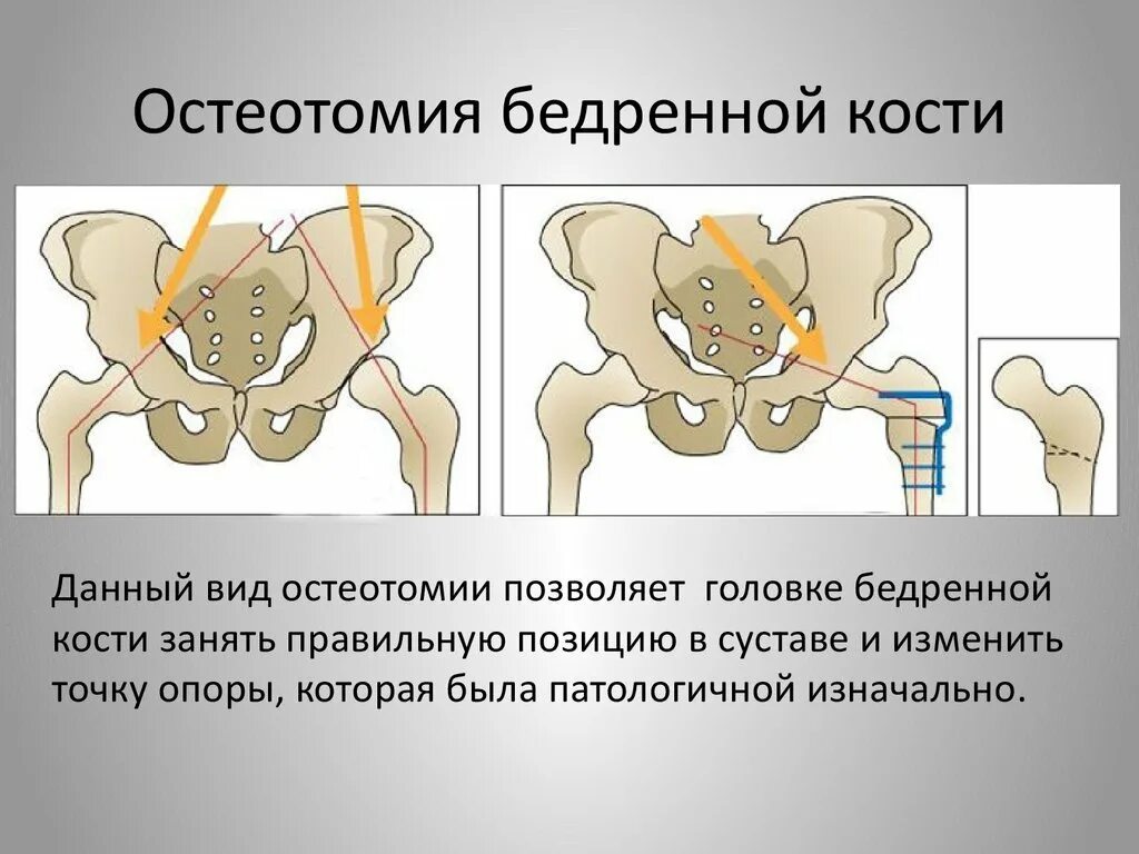 Операция тазобедренный кость