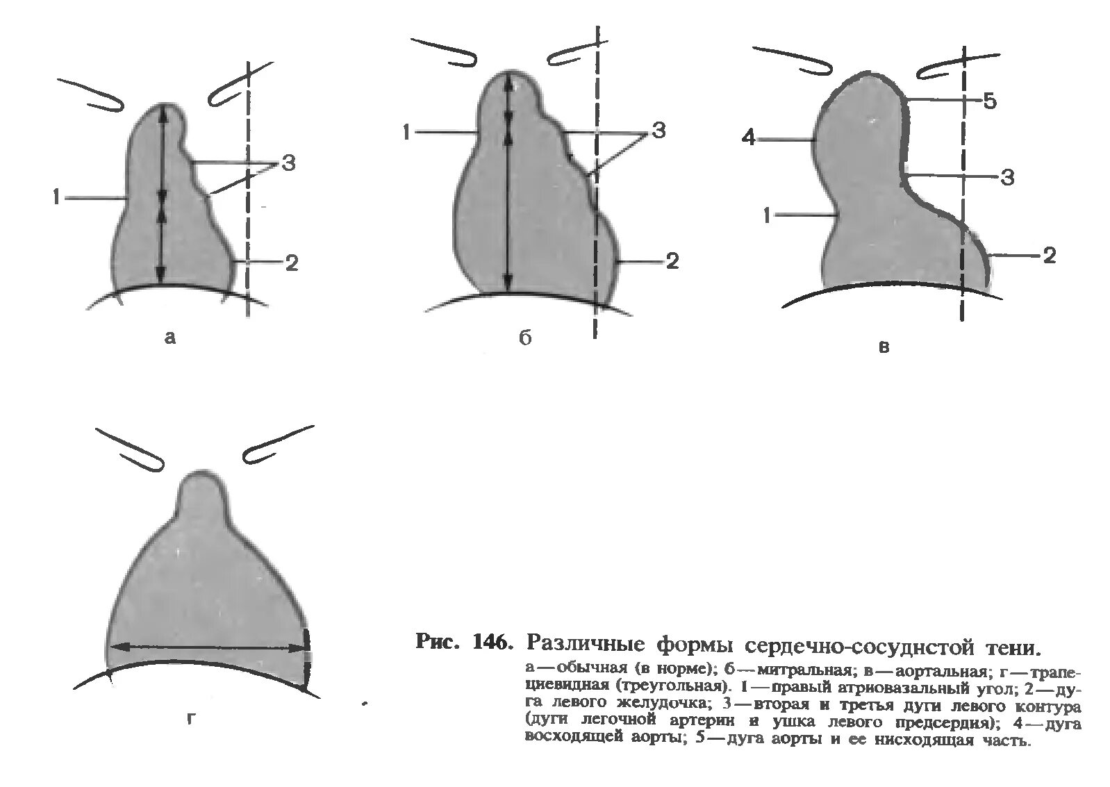 Конфигурации сердца. Аортальная конфигурация сердца схема. конфигурации сердца на рентгенограмме в норме. рентгенологические конфигурации сердца. митральная и аортальная конфигурация сердца на рентгене.