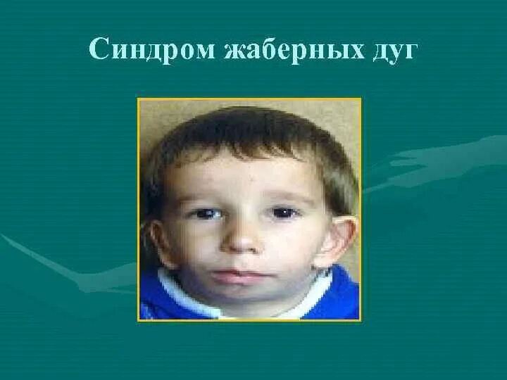 Патология жабер у человека. Синдром 1-2 жаберных дуг. Синдром 1-2 жаберных дуг и Гольденхара. Синдром 1 жаберной дуги.