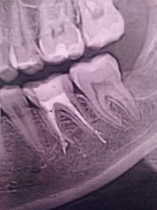 снимок запломбированных каналов. зуб запломбированными корнями. периапикальный периодонтит. запломбированные каналы на снимке. запломбировать новостей одолжить.