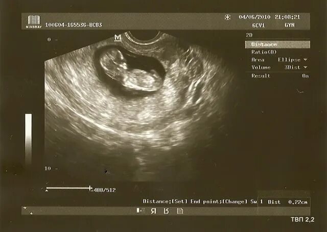 Норма твп в 13 недель беременности. Твп 2 мм. Толщина воротникового пространства в 12 недель норма. Твп на 12 неделе беременности норма таблица. Твп 2,1 мм.