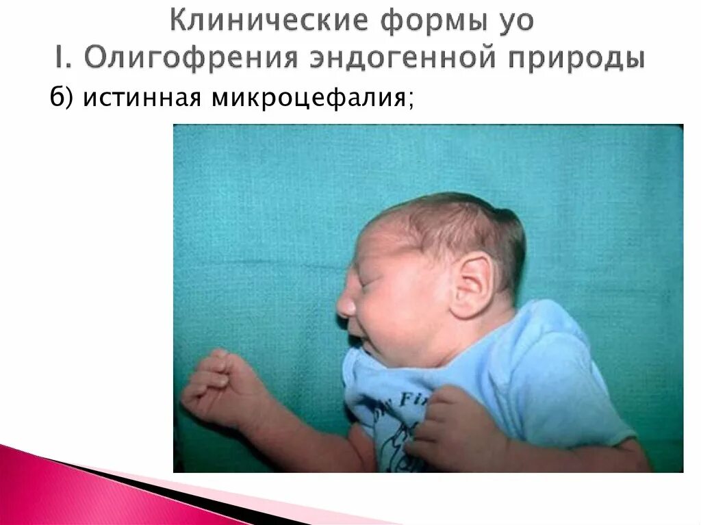Пример олигофрении