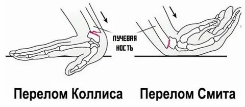 Перелом лучевой кости без гипса