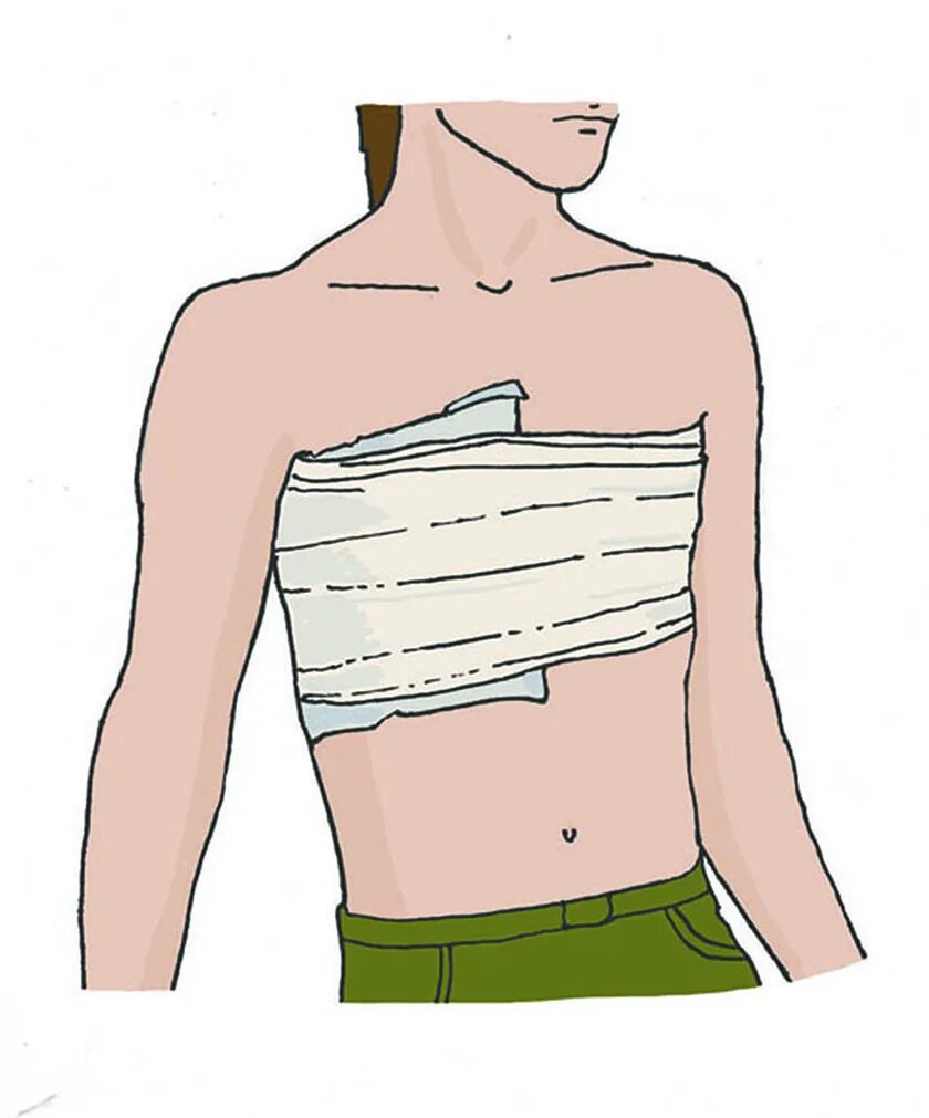 Кровотечение груди. Пневмоторакс окклюзионная повязка. Непроникающее ранение грудной клетки. Окклюзионная повязка при травме груди. Перелом ребер бинтование.