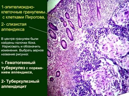 Клетки туберкулезного бугорка