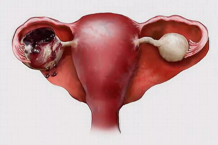 Причины разрыва яичника у женщин. Апоплексия кисты яичника. Апоплексия, разрыв яичников. Геморрагическая апоплексия. Гонорейный сальпингит.