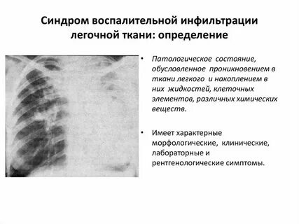 Участки инфильтрации легочной ткани