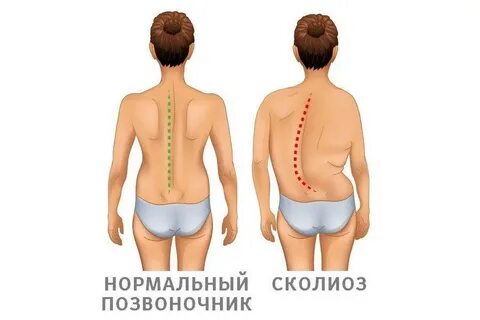 Начинается сколиоз