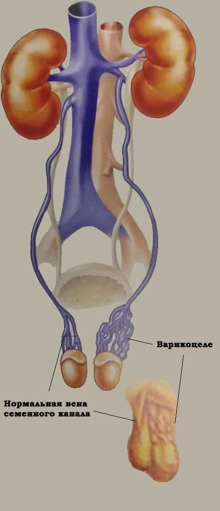 Расширение вен канатика. Варикозное расширение вен семенного канатика. Варикозное расширение вен мошонки у мужчин. Левосторонний варикоз вены семенного канатика. Варикоцеле семенного канатика.