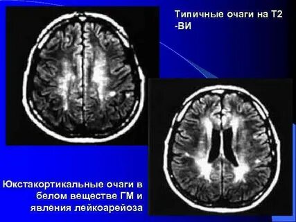 Что такое глиоз в головном мозге