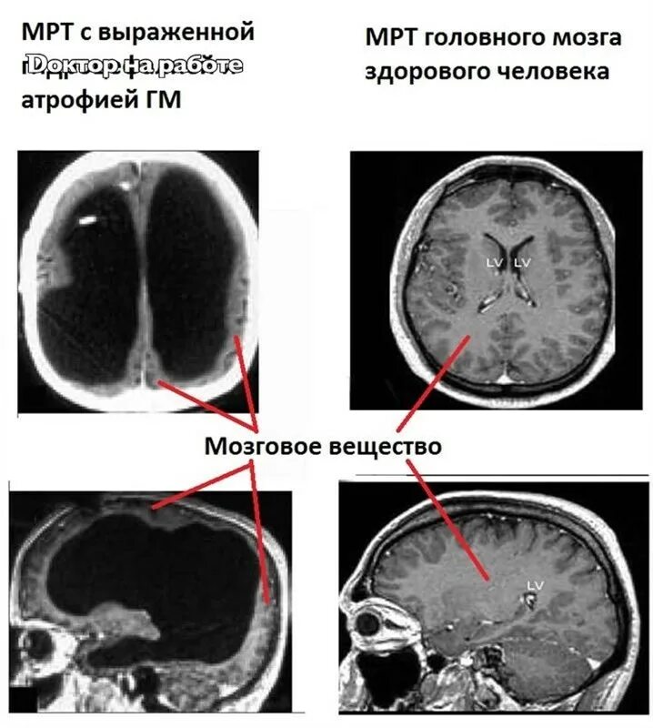 Мрт снимки мозга норма. Снимки мрт головы здорового человека. Снимки мрт головного мозга норма. Снимки мрт головы норма. Атрофия головного мозга 1