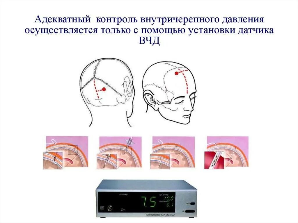 Внутричерепное давление головного мозга