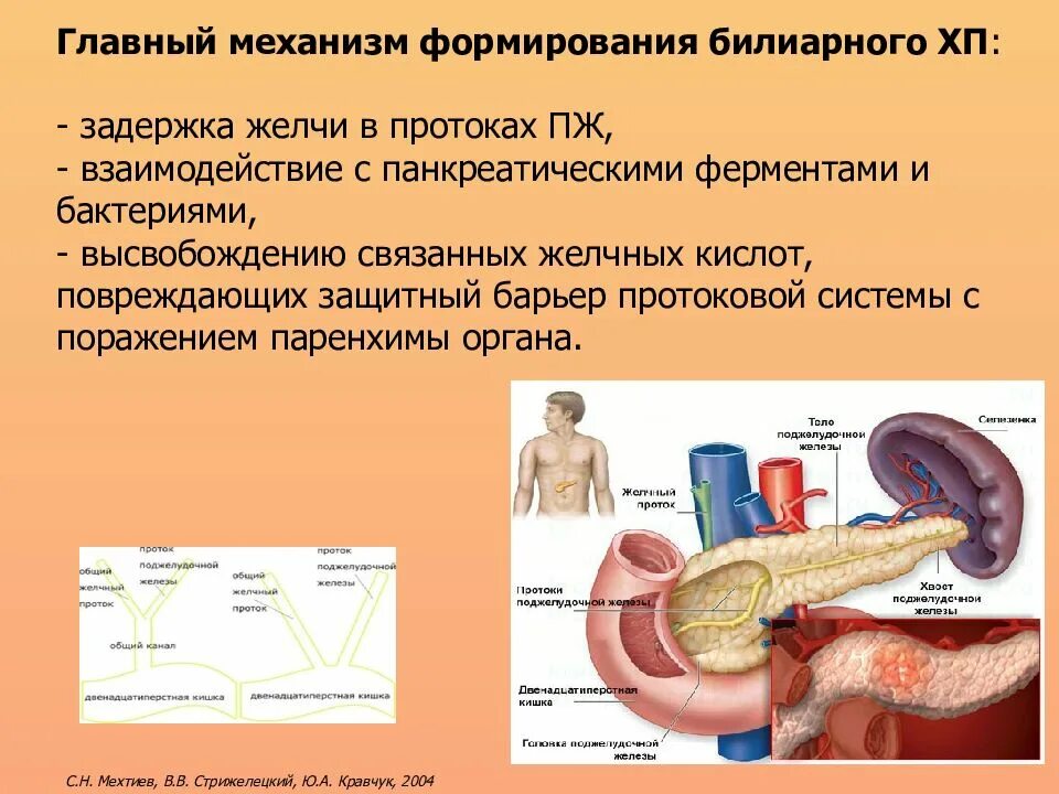 Билиарнозависимый панкреатит панкреатит. Острый билиарный панкреатит. Хронический билиарнозависимый панкреатит. Билиарный острый панкреатит: желчнокаменный панкреатит;. Характеристика хронического панкреатита