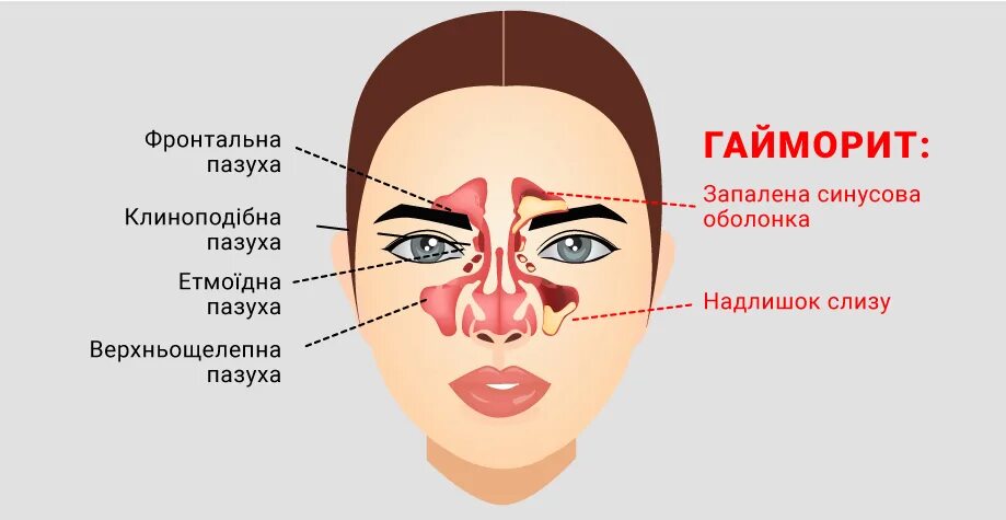 Симптомы гайморита у взрослых без температуры признаки