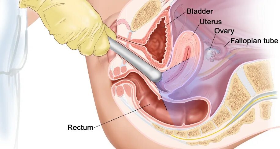 Омт расшифровка в медицине. Что такое омт омт омт. Трансвагинальное узи органов малого таза. Ультразвуковое исследование органов малого таза. Омт расшифровка в банке.