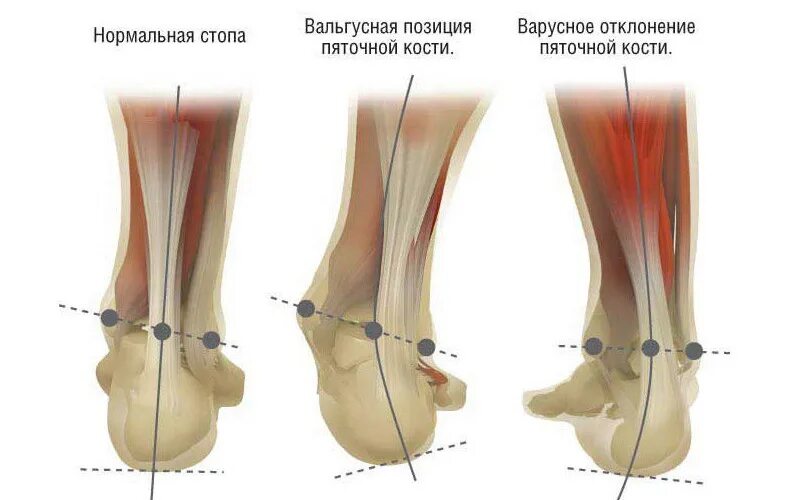 Почему нога уходит в сторону