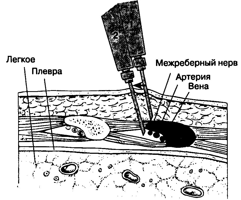 Межреберная блокада. Межреберная новокаиновая блокада показания техника. Техника новокаиновой блокады межреберных нервов. Паравертебральная блокада межреберных нервов. Межреберная новокаиновая блокада алгоритм.