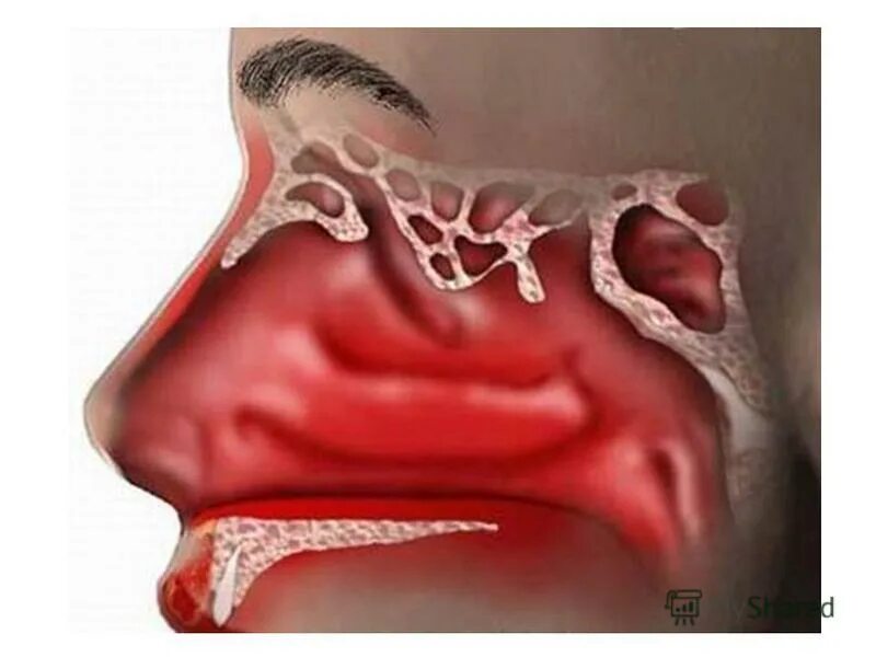 -++воспаление слизистой оболочки носа - ринит. Раздражает слизистую. Раздражает слизистую. Хронический ринофарингит. Гиповитаминозный хейлит.