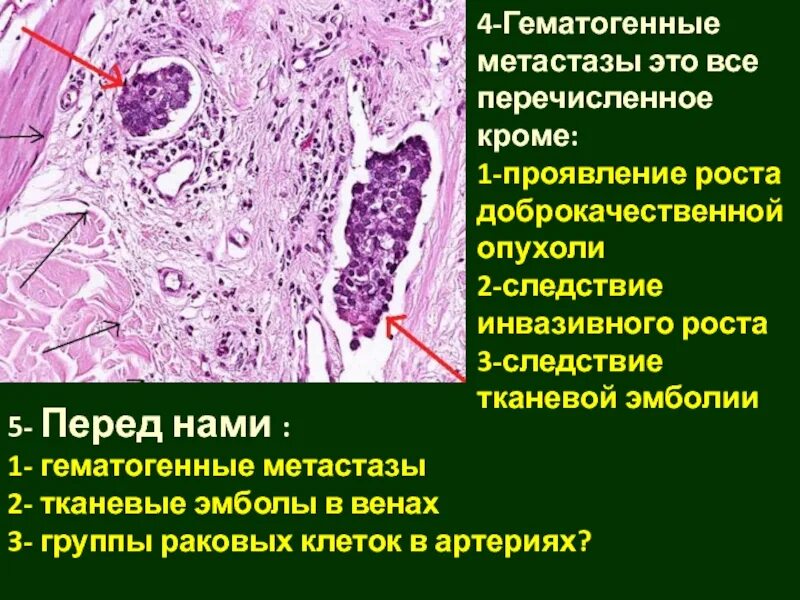 Какой рак метастазирует. Метастазирование доброкачественной опухоли. Гематогенный путь метастазирования опухоли.