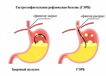 Отрыжка и изжога после еды причины