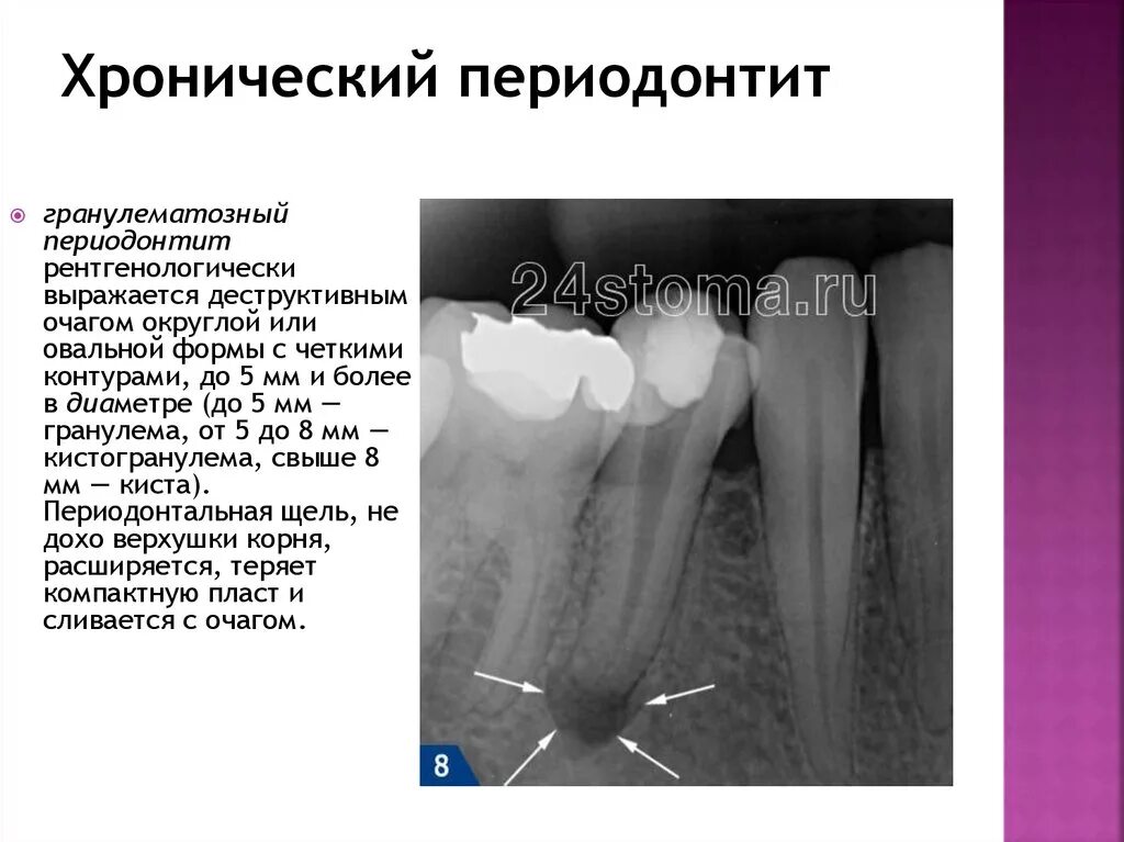 Обострение хронического гранулирующего