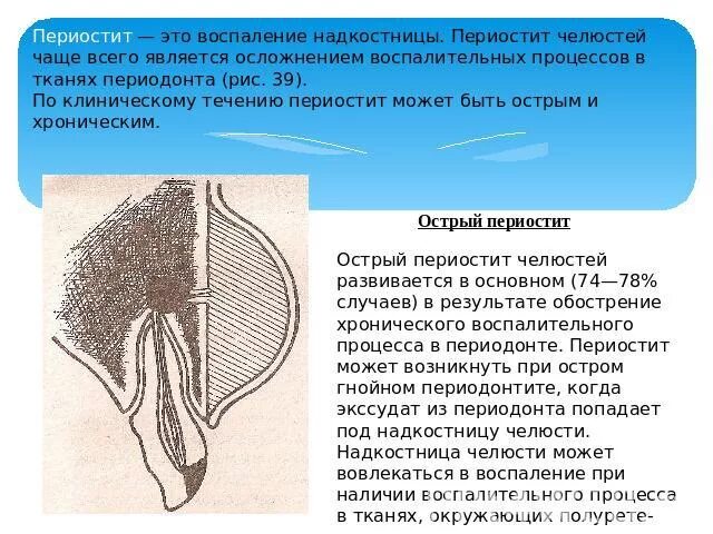 Ретромолярный периостит. Парастит нижней челюсти. Хронический периостит этиология. Серозный периостит локальный статус. Периостит осложнения.