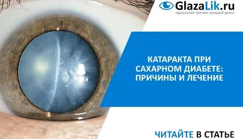 Катаракта кто делал отзывы