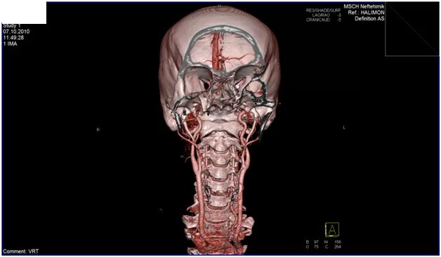 Ангиография позвоночной артерии. Позвоночная артерия МСКТ. Позвоночная артерия кт. Мрт шейного отдела позвоночника и ангиография артерий шеи.