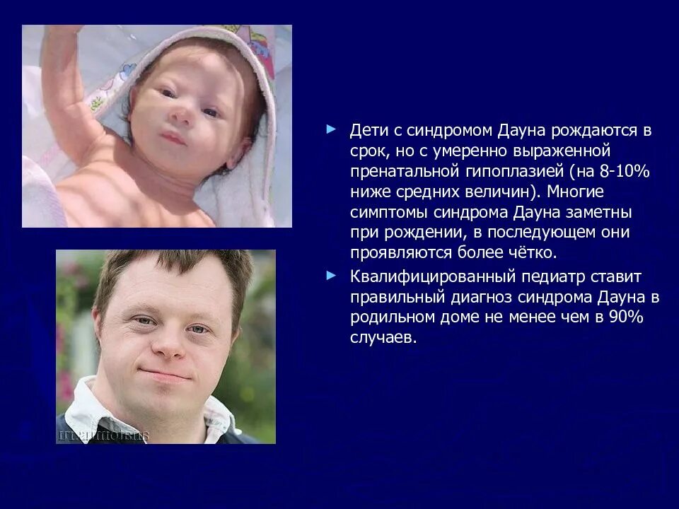 Синдром м р. Внешность детей с синдромом дауна.