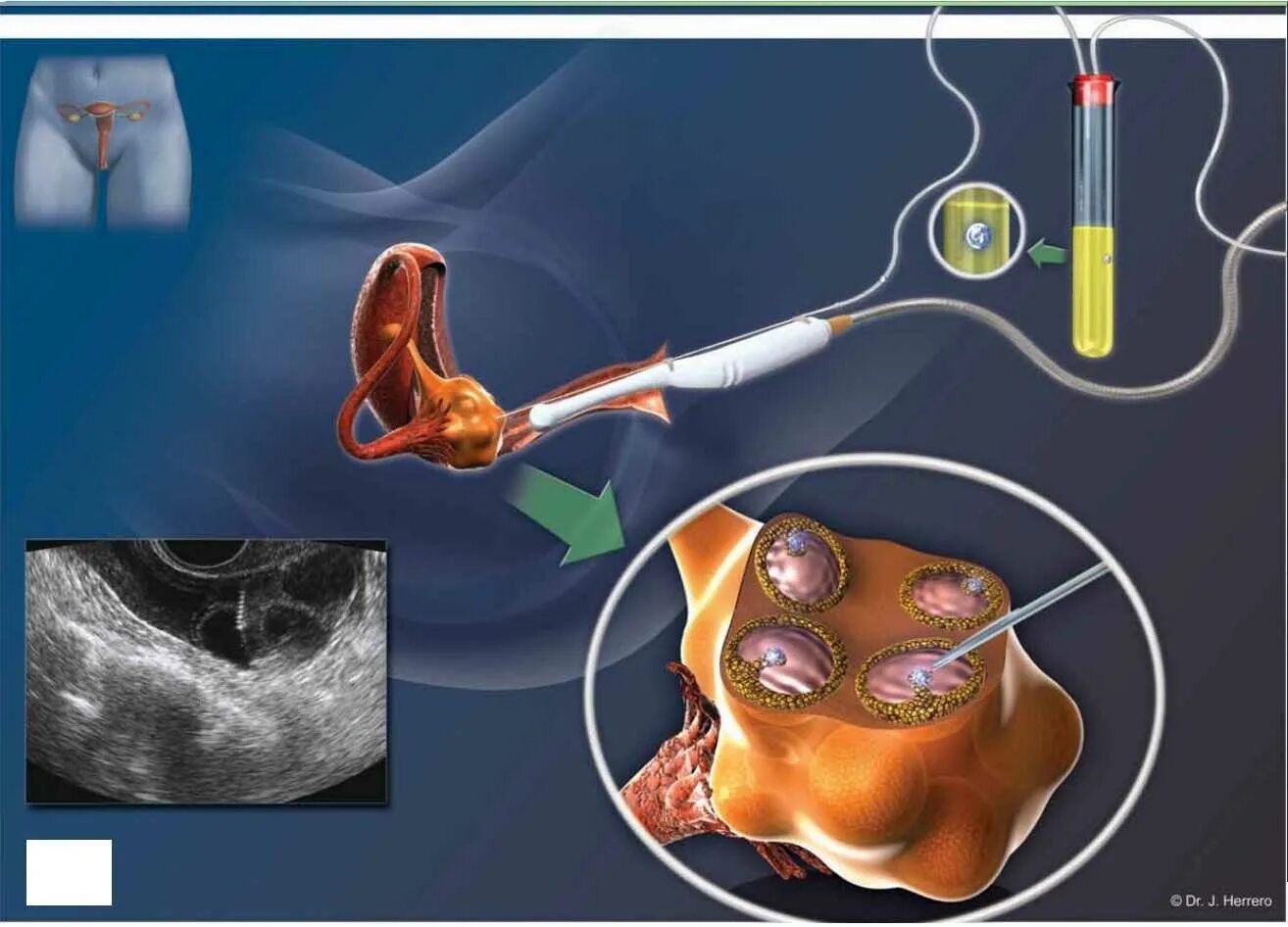 Трансвагинальная пункция фолликулов. Эко пункция яйцеклеток. Пункция фолликулов яичников. Пункция фолликулов яичника при эко.