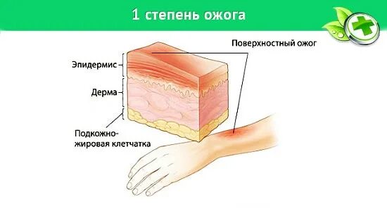 Первая стадия. Ожог 1 степени характеризуется.