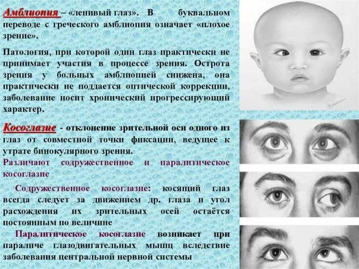 У ребенка зрение 1 5. Амблиопия ленивый глаз. Нарушение зрения косоглазие. Косоглазие и амблиопия.