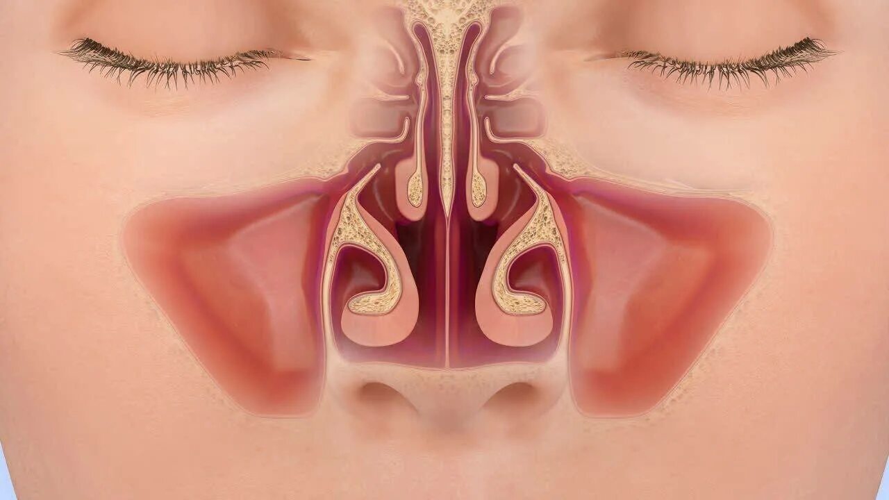 Почему закладывает нос в положении. Вазомоторный ринит носовые раковины. Атрофический ринит риноскопия. Синусит и вазомоторный ринит. Гипертрофический ринит искривление носовой перегородки.