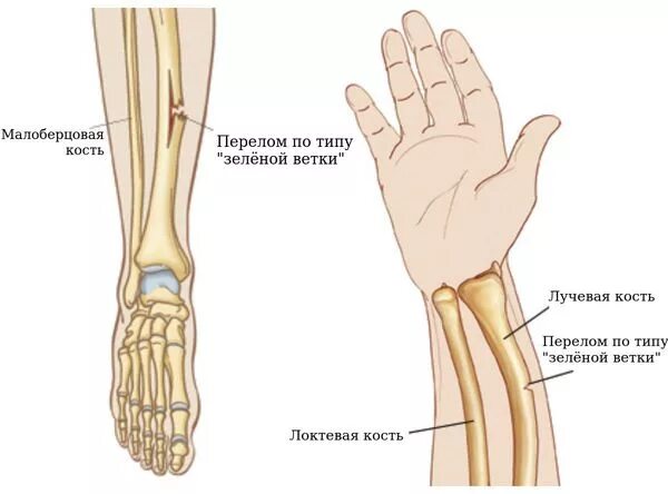 Перелом лучевой кости по типу зеленой веточки у детей. Зеленая веточка перелом лучевой кости. Перелом лучевой кости по типу зеленой веточки. Поднадкостничные переломы по типу зеленой веточки. Как понять что у тебя трещина