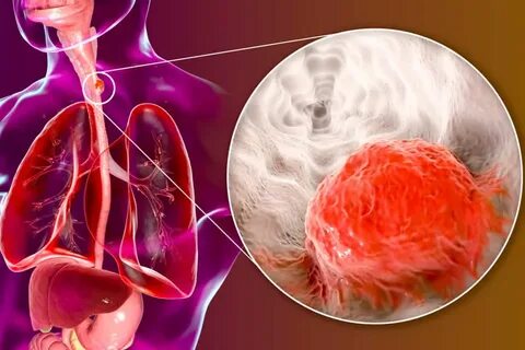 Esophageal cancer