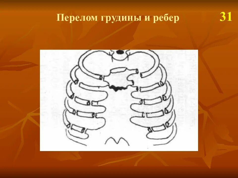 повязка при переломе ребер. симптомы при переломе ребра. тесты на перелом ребра. сегментарный перелом ребра. давящая повязка на ребра.