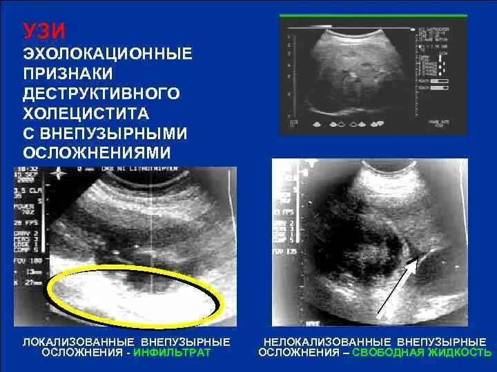 Эхопризнаки желчного пузыря. Острый деструктивный калькулезный холецистит. Бескаменный холецистит УЗИ. Острый калькулезный холецистит на УЗИ. Хронический бескаменный холецистит УЗИ.